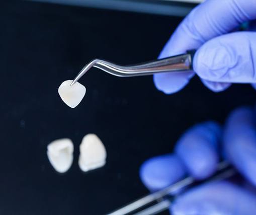 Close up of a dental veneer