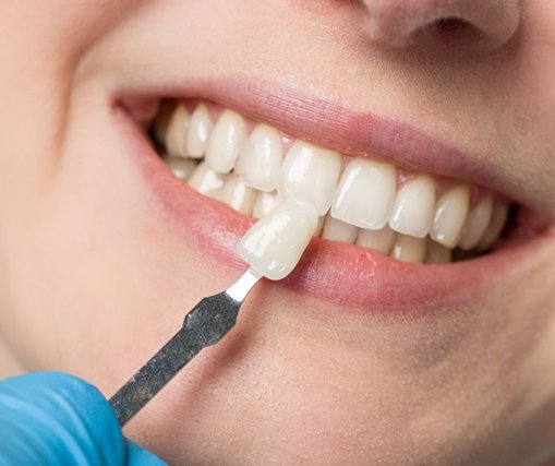 Close up of dentist placing a dental veneer